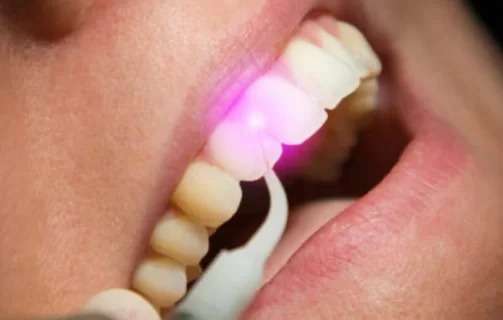 Laser Gum Surgery